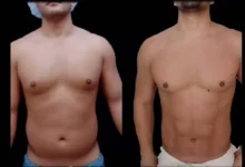 Liposuction in Dubai