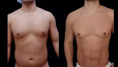 Liposuction in Dubai