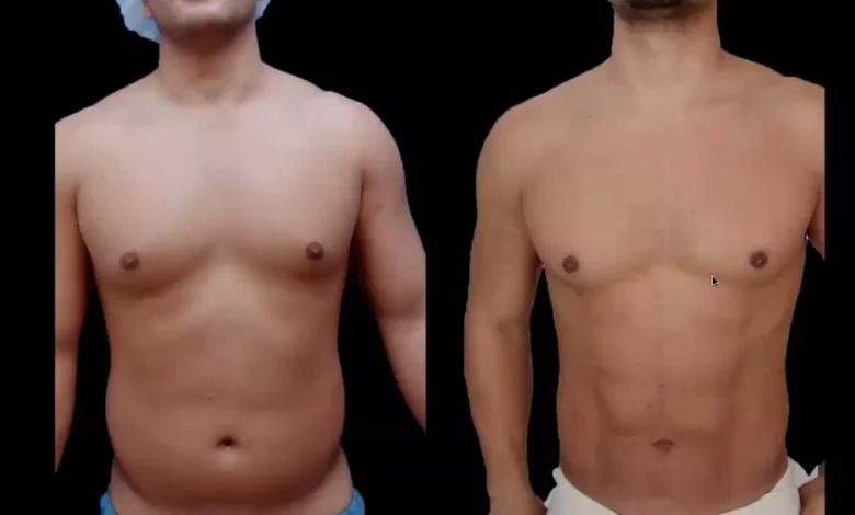 Liposuction in Dubai